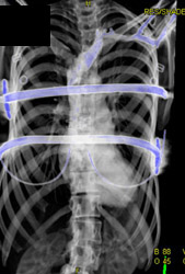 Prior Pectus Repair - CTisus CT Scan