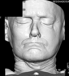 3D of Face - CTisus CT Scan