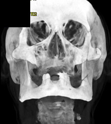 Mandibular Fracture - CTisus CT Scan