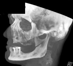 Mandibular Fracture - CTisus CT Scan