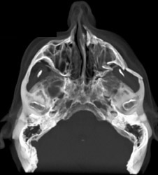 Orbital and Zygomatic Arch Fracture - CTisus CT Scan