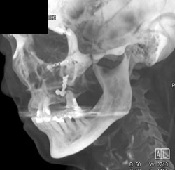 Orbital Fracture and Repair - CTisus CT Scan
