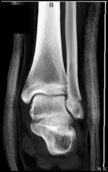 Fibular Fracture - CTisus CT Scan