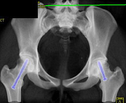 Slipped Capital Femoral Epiphysis (SCFE) With Pinning - CTisus CT Scan