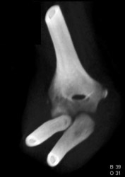 Elbow Fracture - CTisus CT Scan