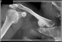 Osteoma Clavicle - CTisus CT Scan