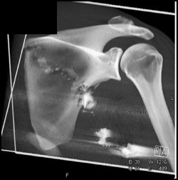 Gunshot Wound to Scapula - CTisus CT Scan