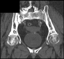 Stress Fracture Sacrum - CTisus CT Scan