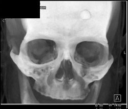 Osteoma - CTisus CT Scan