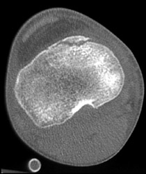 Tibial Plateau Fracture - CTisus CT Scan