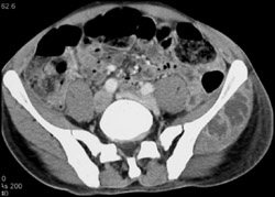 Abscess - CTisus CT Scan