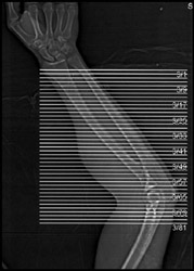 Topogram of Arm Ct - CTisus CT Scan