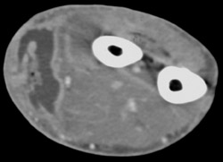 Abscess in Forearm - CTisus CT Scan