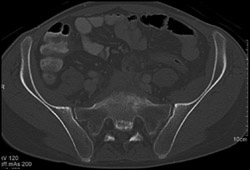 Osteomyelitis Sacrum - CTisus CT Scan