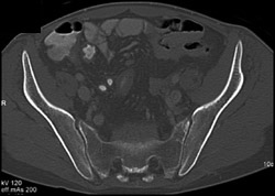 Osteomyelitis - Musculoskeletal Case Studies - CTisus CT Scanning