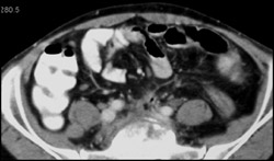 Osteomyelitis With Abscess - CTisus CT Scan