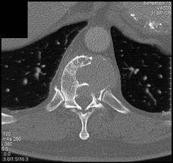 Multiple Myeloma - CTisus CT Scan