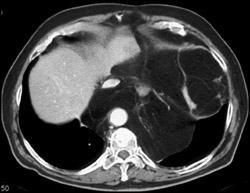 Liposarcoma - CTisus CT Scan