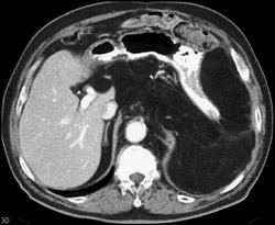 Liposarcoma - CTisus CT Scan