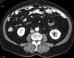 Liposarcoma - CTisus CT Scan