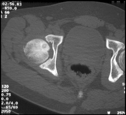 Osteoid Osteoma - CTisus CT Scan