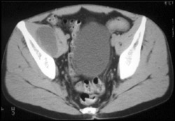 Psoas Abscess - Musculoskeletal Case Studies - CTisus CT Scanning