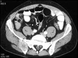 Metastatic Renal Cell Carcinoma - CTisus CT Scan