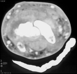 Abscess - CTisus CT Scan