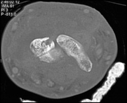 Abscess and Osteomyelitis - CTisus CT Scan