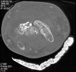 Abscess - CTisus CT Scan