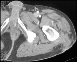 Abscess - CTisus CT Scan