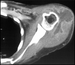 Abscess - CTisus CT Scan