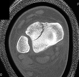 Tibial Fracture - CTisus CT Scan