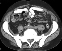 Extramedullary Hematopoiesis in Spinal Canal - CTisus CT Scan