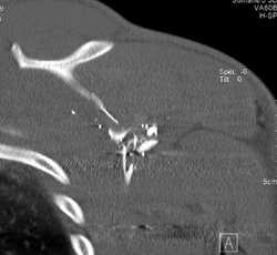 Gun Shot Wound to Scapula With Fracture - CTisus CT Scan