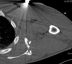 Scapular Fracture - CTisus CT Scan