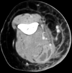 Abscess at Level of Elbow - CTisus CT Scan