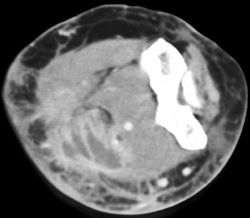 Intramuscular Abscess - CTisus CT Scan