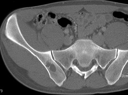 Benign Cyst - CTisus CT Scan