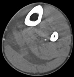 Gastrocnemius Tear - CTisus CT Scan