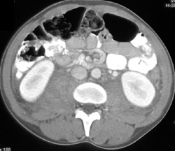 Psoas Bleeds - CTisus CT Scan