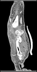 Abscess - CTisus CT Scan