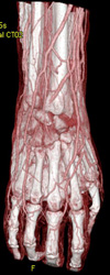 Ct Angiogram and Soft Tissue 3D - CTisus CT Scan