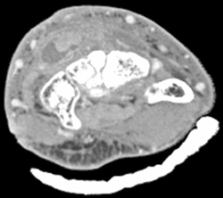 Abscess - CTisus CT Scan