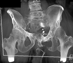 Insufficiency Fractures - CTisus CT Scan