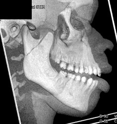 Mandibular Fracture - CTisus CT Scan