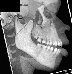 Mandibular Fracture - CTisus CT Scan