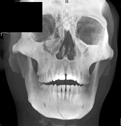 Mandibular and Orbital Fractures - CTisus CT Scan