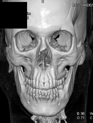 Mandibular Fracture - CTisus CT Scan