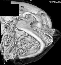 Mandibular Fracture - CTisus CT Scan